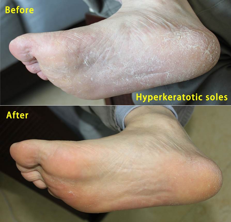 before and after treatment with anti-funal intelligel
